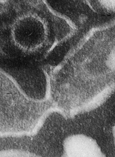 Ученые связывают волчанку с вирусом, который есть у 95% людей