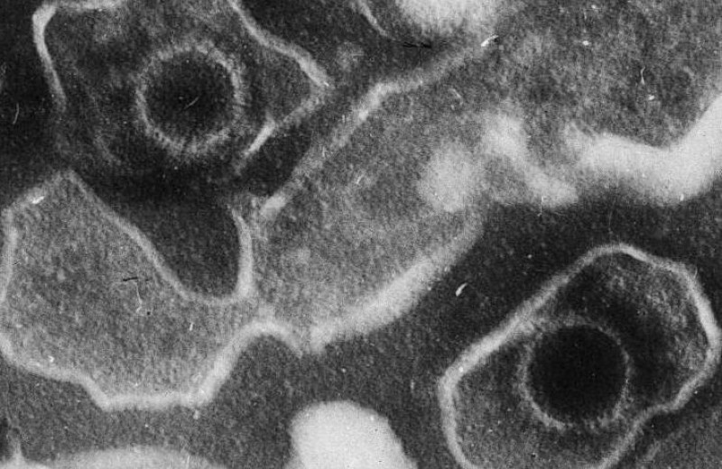 Ученые связывают волчанку с вирусом, который есть у 95% людей