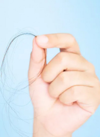 «Я лысею»: реальная история потери волос