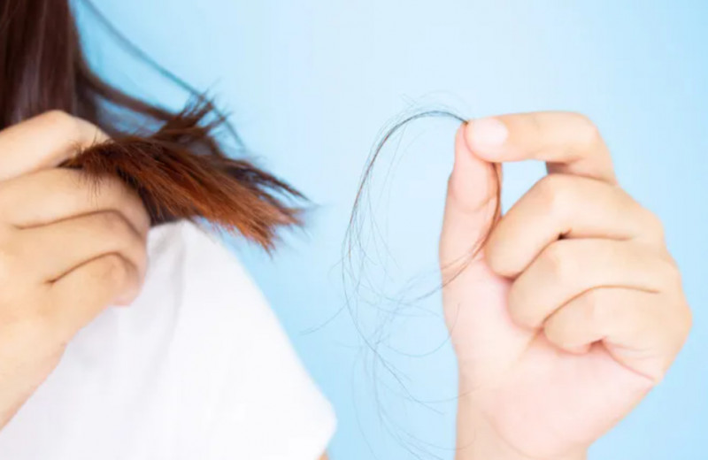 «Я лысею»: реальная история потери волос