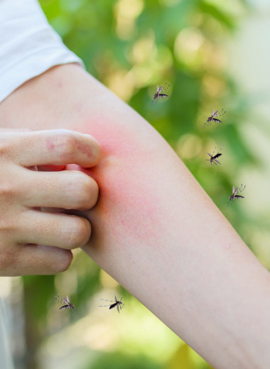 Когда спреи не помогли: 7 простых шагов, как снять зуд от укуса комара в домашних условиях