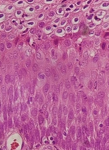 Анализ менструальной крови не уступил мазкам при скрининге на рак шейки матки