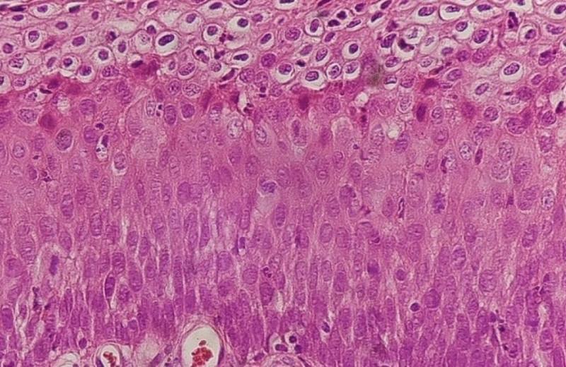 Анализ менструальной крови не уступил мазкам при скрининге на рак шейки матки