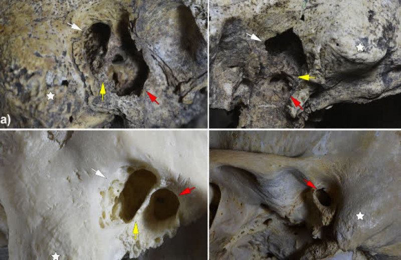 Палеопатологи обнаружили древнейшие свидетельства мастоидотомии