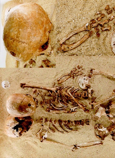 У юной кроманьонки выявили акромезомелическую дисплазию