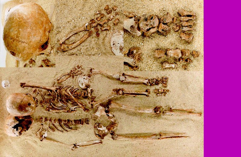 У юной кроманьонки выявили акромезомелическую дисплазию