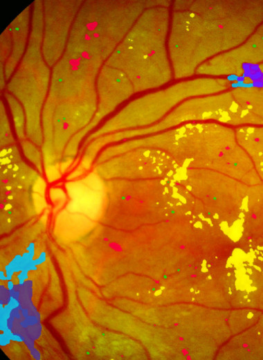 Искусственный интеллект поможет сберечь зрение
