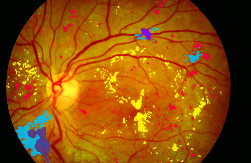 Искусственный интеллект поможет сберечь зрение